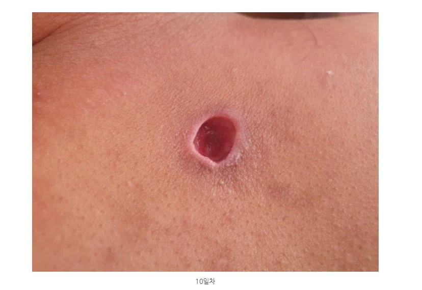 극혐) 조선시대에 등창으로 죽은 사람이 많았던 이유_4.webp