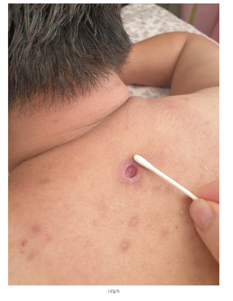 극혐) 조선시대에 등창으로 죽은 사람이 많았던 이유_5.webp