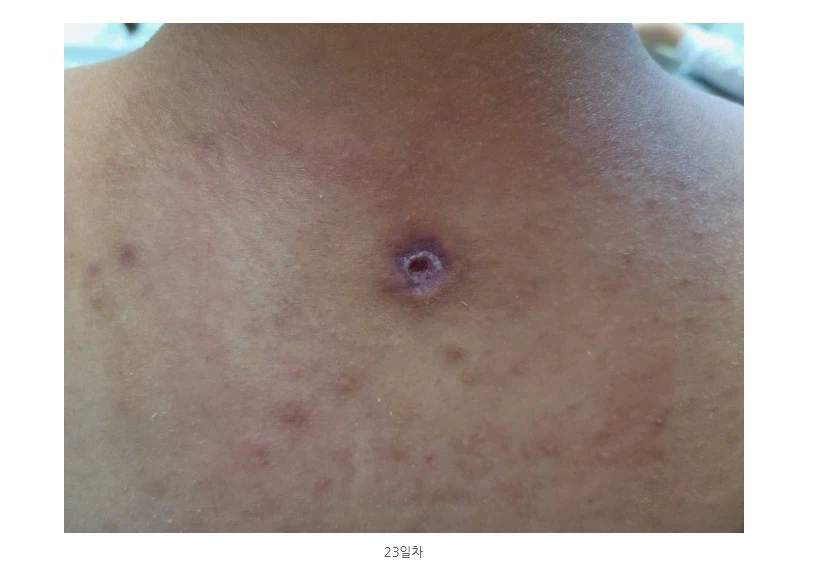 극혐) 조선시대에 등창으로 죽은 사람이 많았던 이유_6.webp