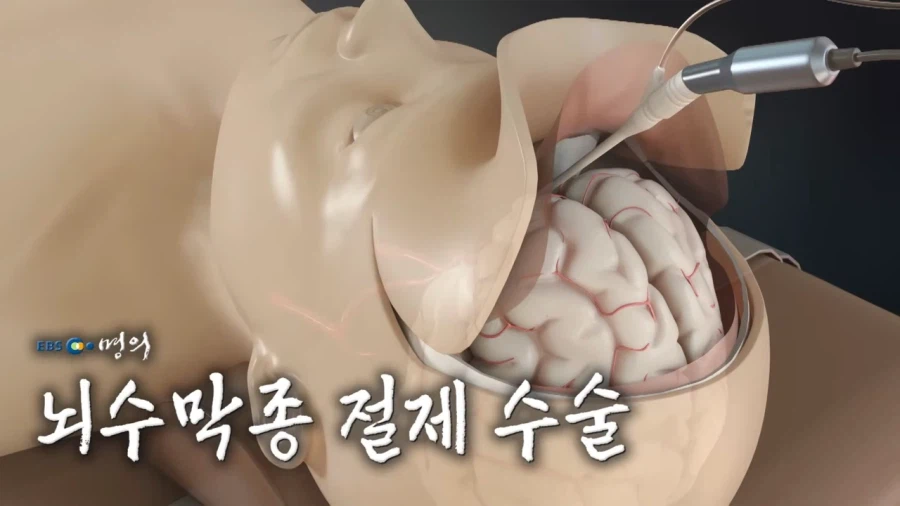 뇌수막종 수술방법_1.webp