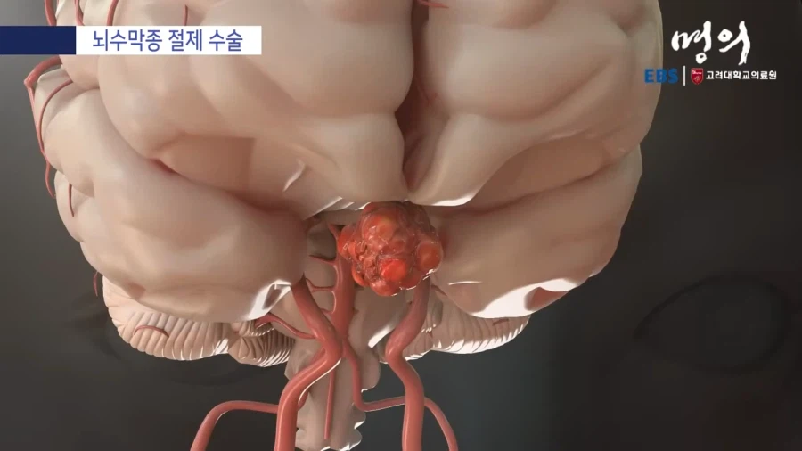 뇌수막종 수술방법_2.webp