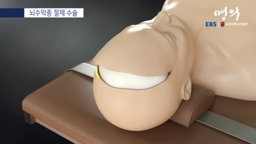 뇌수막종 수술방법_3.webp