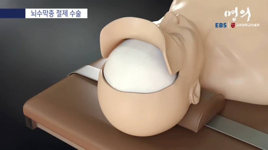 뇌수막종 수술방법_4.webp