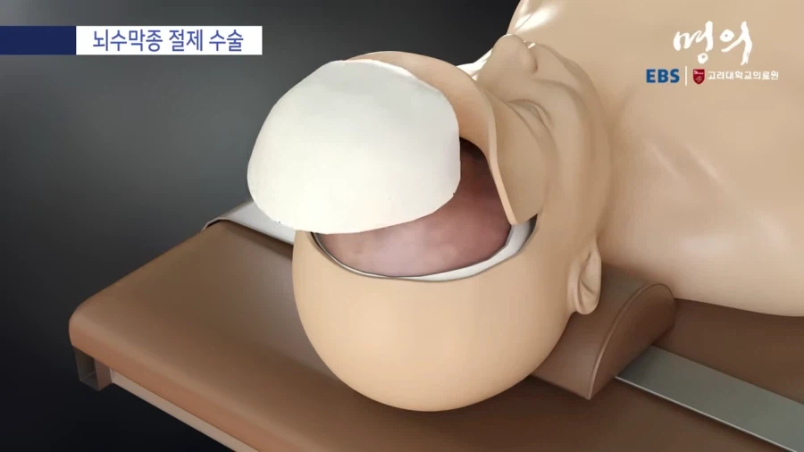 뇌수막종 수술방법_5.webp