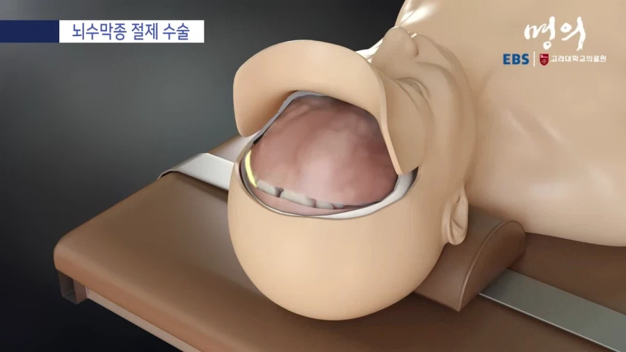 뇌수막종 수술방법_6.webp