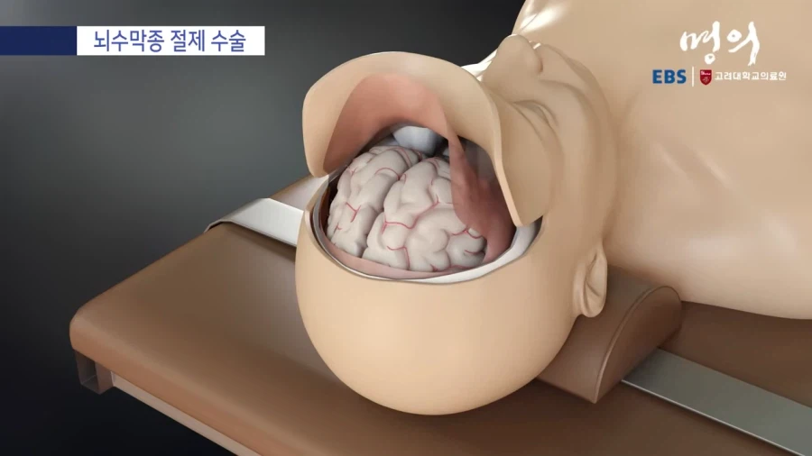 뇌수막종 수술방법_7.webp