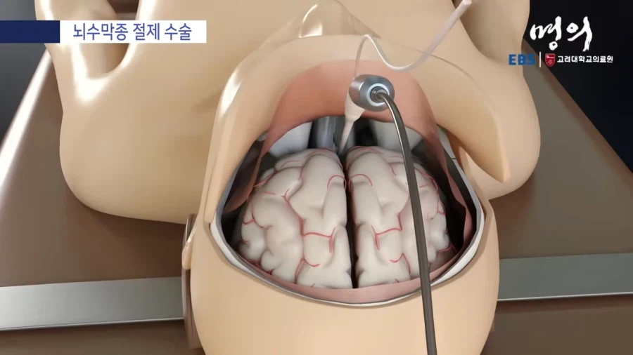 뇌수막종 수술방법_8.webp