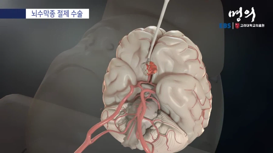 뇌수막종 수술방법_9.webp