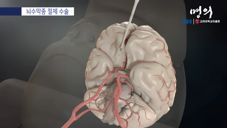 뇌수막종 수술방법_10.webp