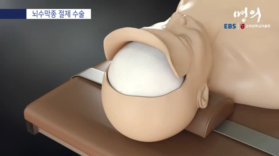 뇌수막종 수술방법_12.webp