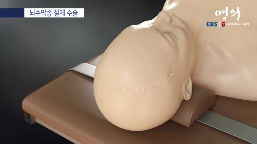 뇌수막종 수술방법_13.webp