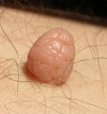 피부병중에 가장 ↗같은 피부병_2.webp