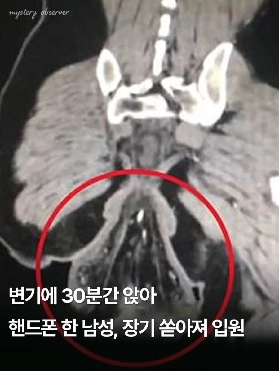 똥 쌀 때 핸드폰 하지 말라는 이유.jpg_1.webp