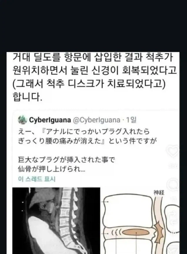 허리디스크를 쉽게 치료하는 방법_1.webp