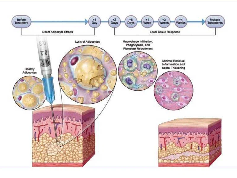 지방세포 관련 수술에 대한 사람들의 오해_1.webp