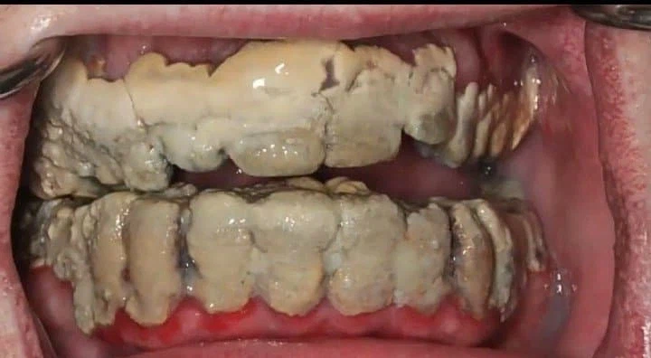 (혐)평생 이 안닦아본 사람_1.webp