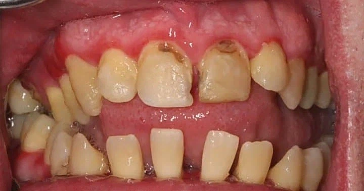 (혐)평생 이 안닦아본 사람_2.webp