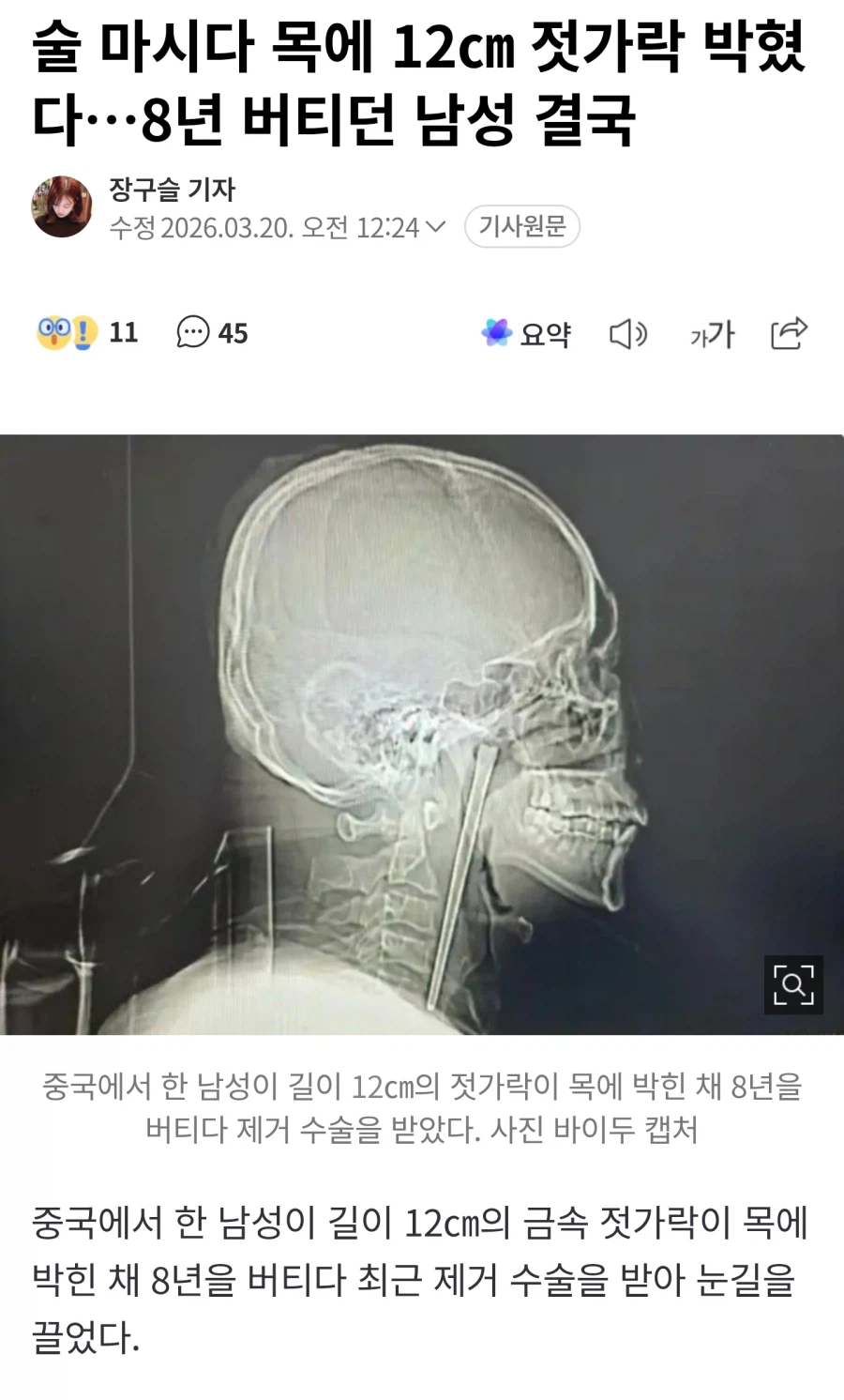 술 마시다 목에 12㎝ 젓가락 박혔다…8년 버티던 남성 결국_1.webp