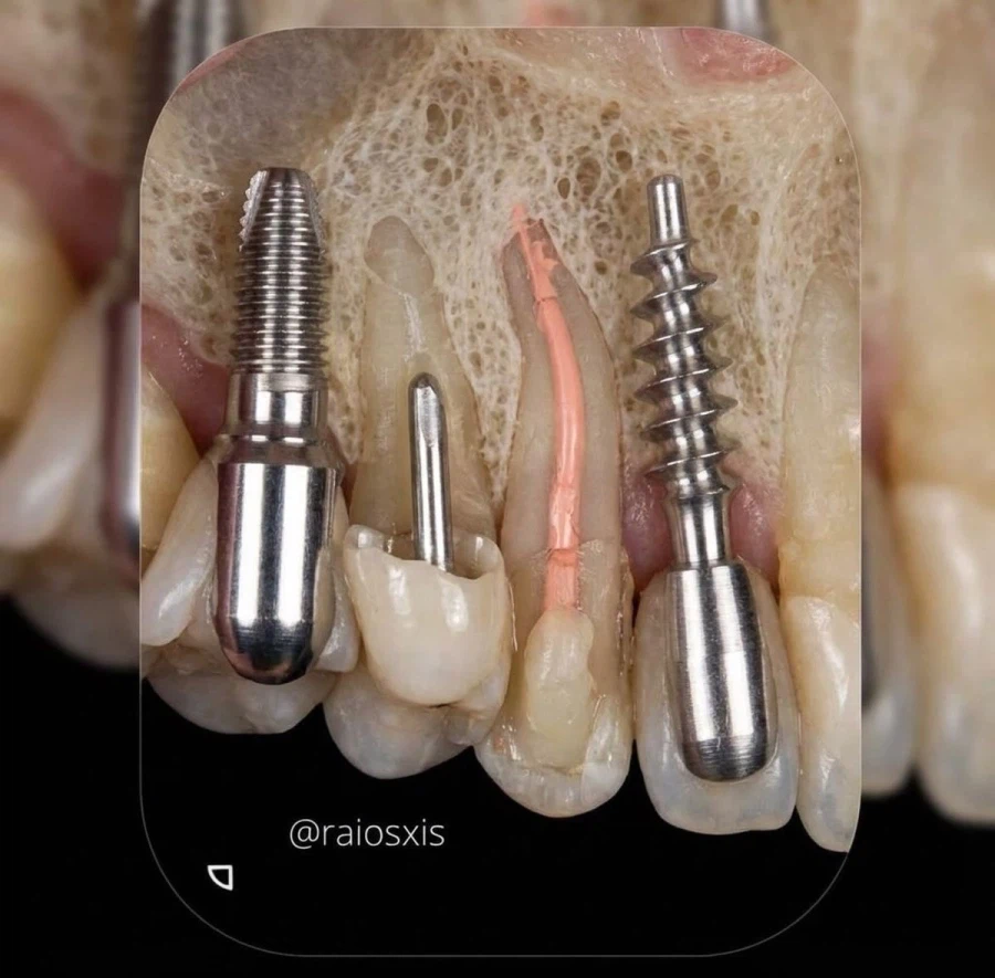 임플란트 잇몸 약하면 못하는 이유_1.webp