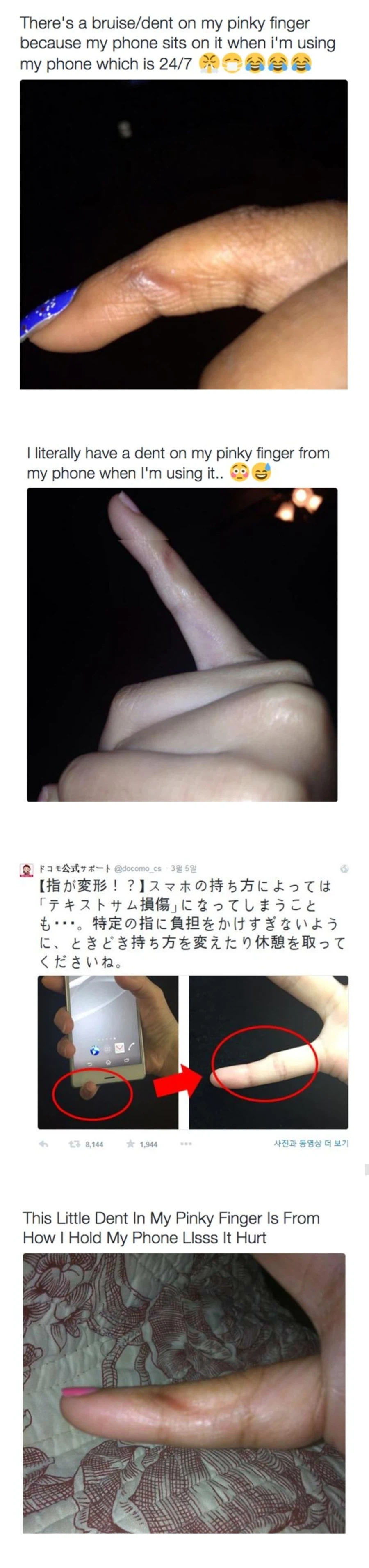 핸드폰 때문에 새끼손가락 변형 온 사람들의 모임.jpg_1.webp