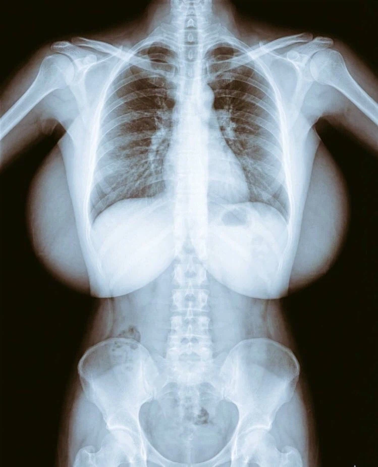 K컵 엑스레이_1.webp