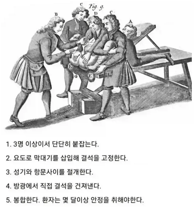 중세시대 요로결석 치료법.jpg_1.webp