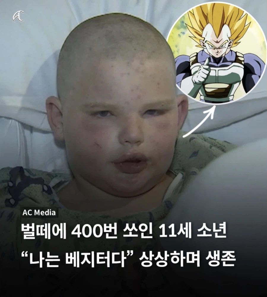 벌떼에 400번 쏘인 소년_1.webp