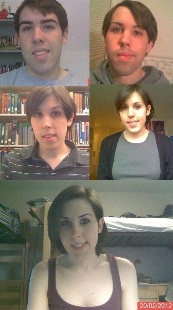 남자가 14개월간 여성호르몬 주사맞은 모습_1.webp