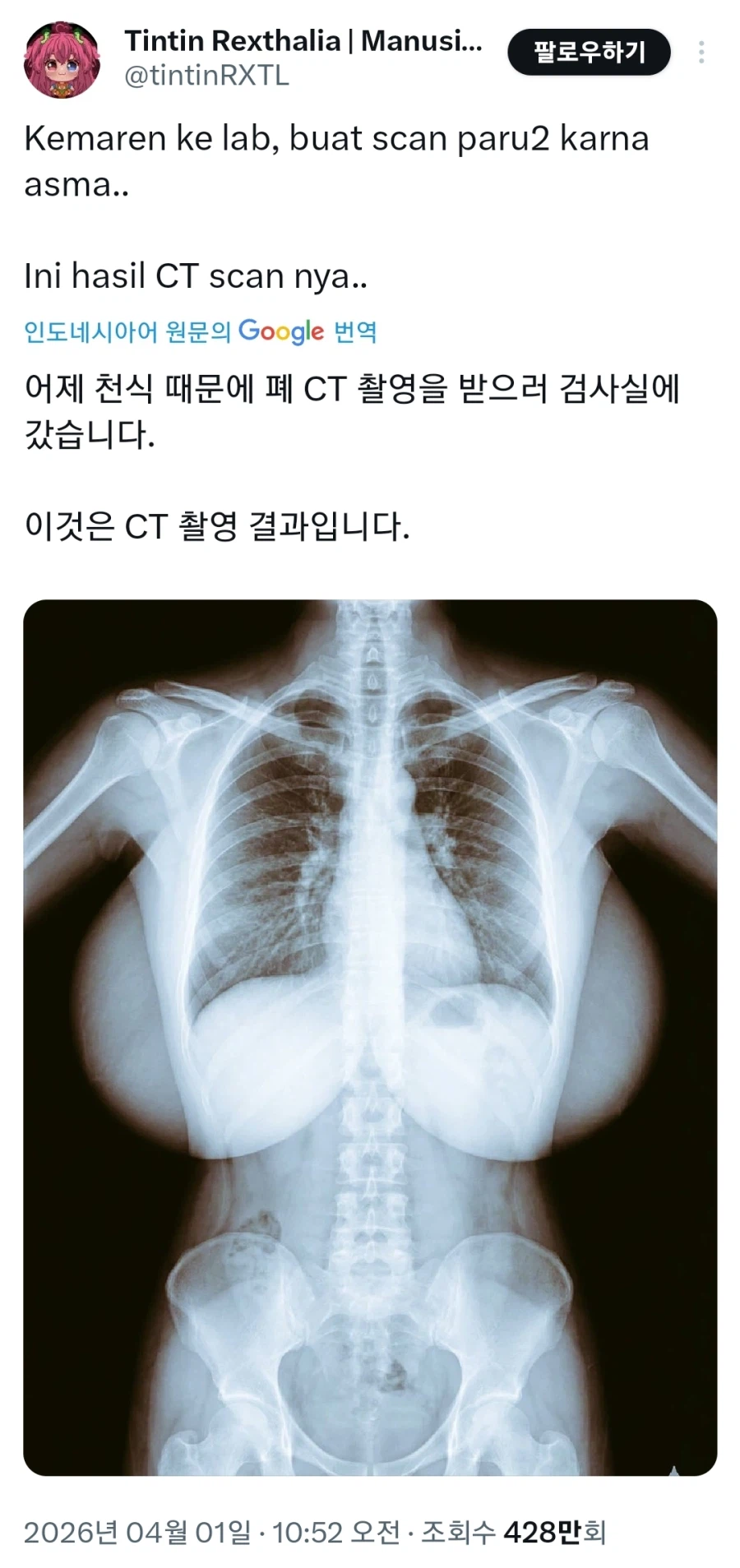 천식 때문에 CT 찍은 사람.jpg_1.webp