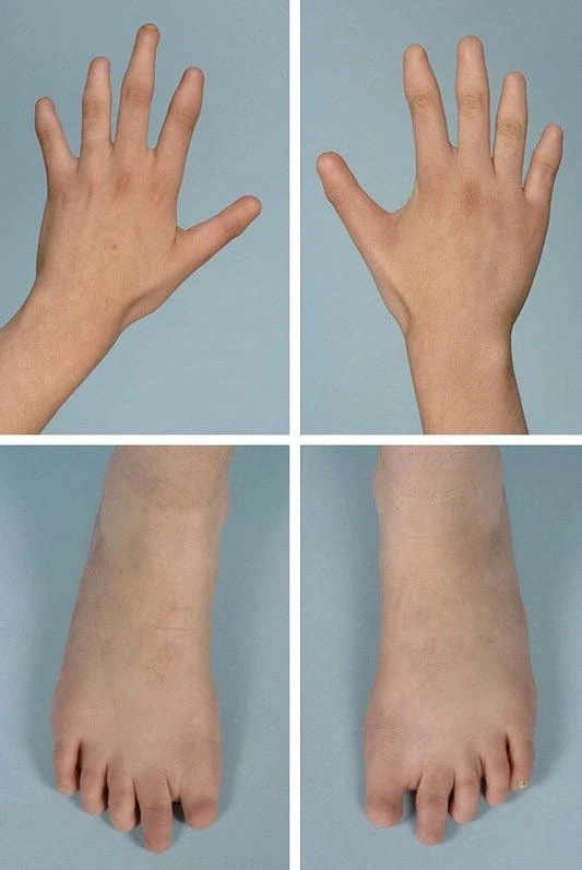 신기한 선천적 희귀병_3.webp