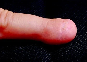 신기한 선천적 희귀병_1.webp