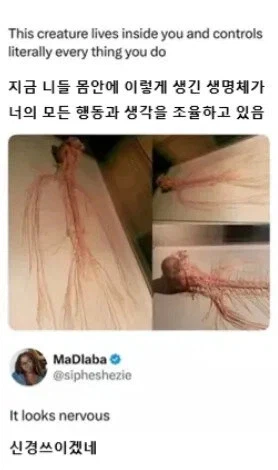 인간의 몸에서 적출된 초거대 기생생물_1.webp