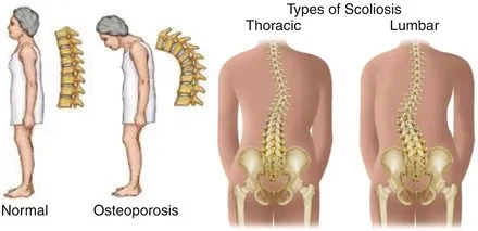척추 척척추 척추 척척추_1.webp