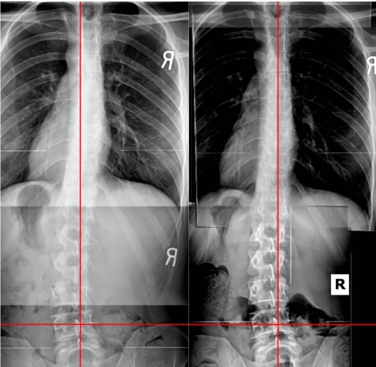 척추 척척추 척추 척척추_2.webp
