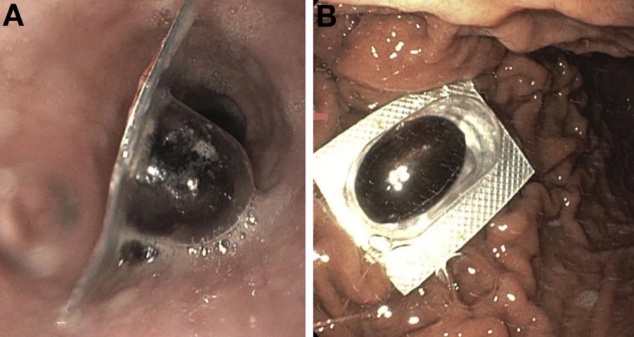 약혐)약을 먹어도 효과가 없다는 환자의 내시경_1.webp