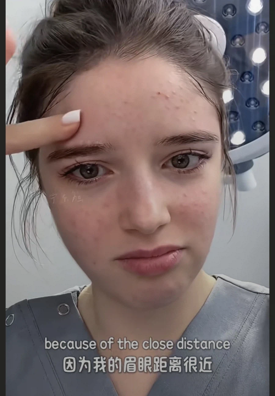 눈과 눈썹 간격을 벌려주는 수술 원리.jpg_1.webp