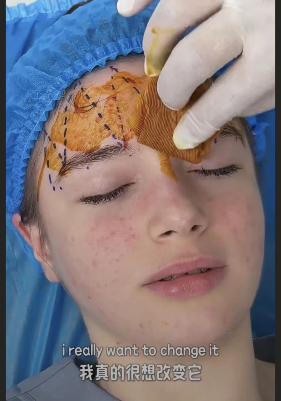 눈과 눈썹 간격을 벌려주는 수술 원리.jpg_2.webp