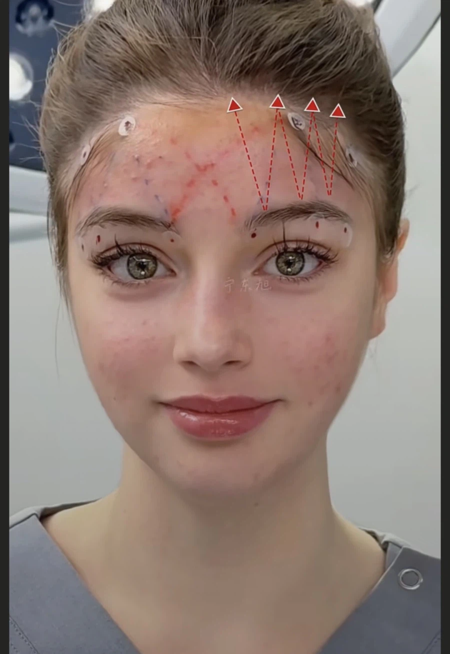 눈과 눈썹 간격을 벌려주는 수술 원리.jpg_3.webp