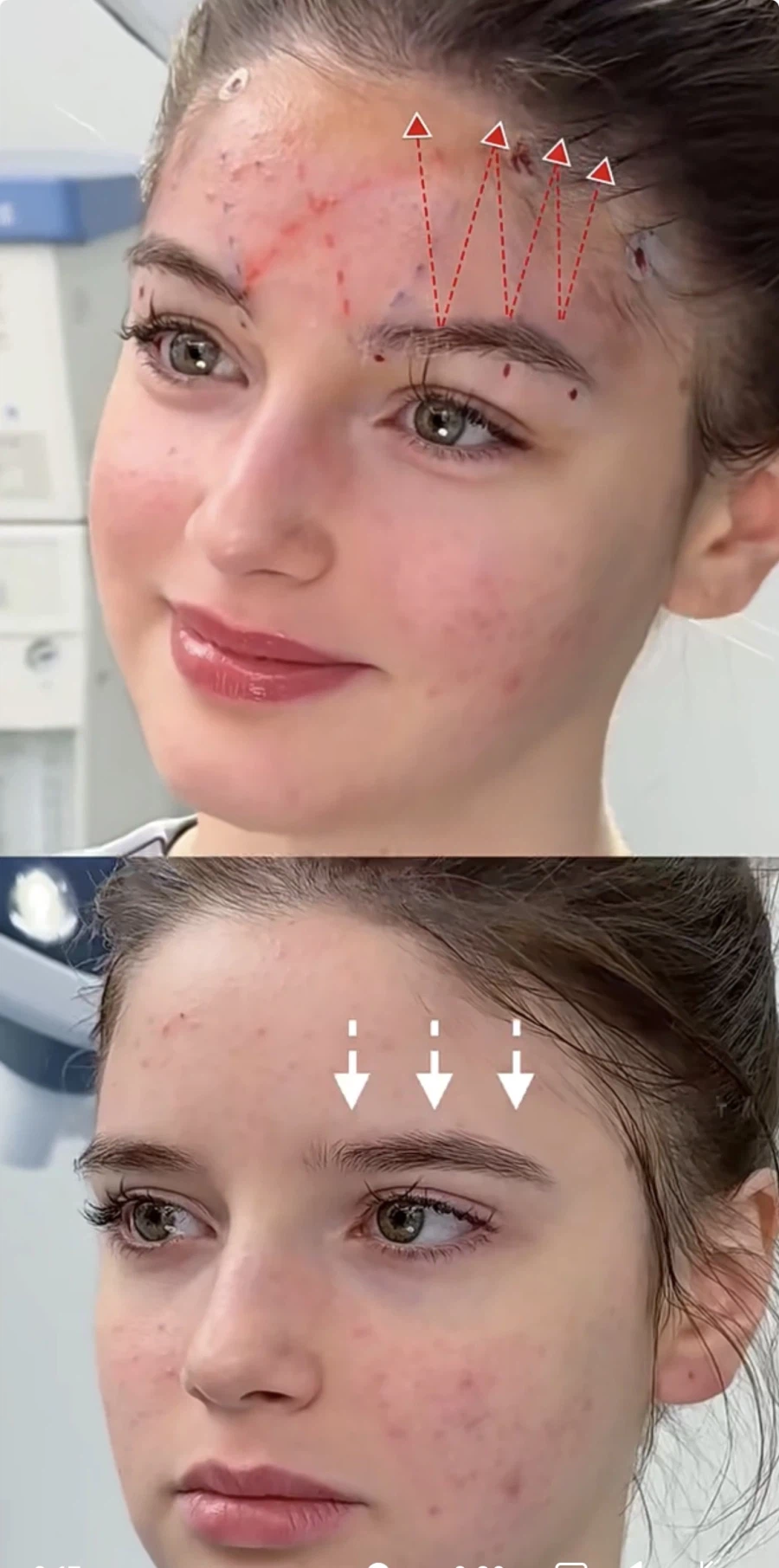 눈과 눈썹 간격을 벌려주는 수술 원리.jpg_4.webp