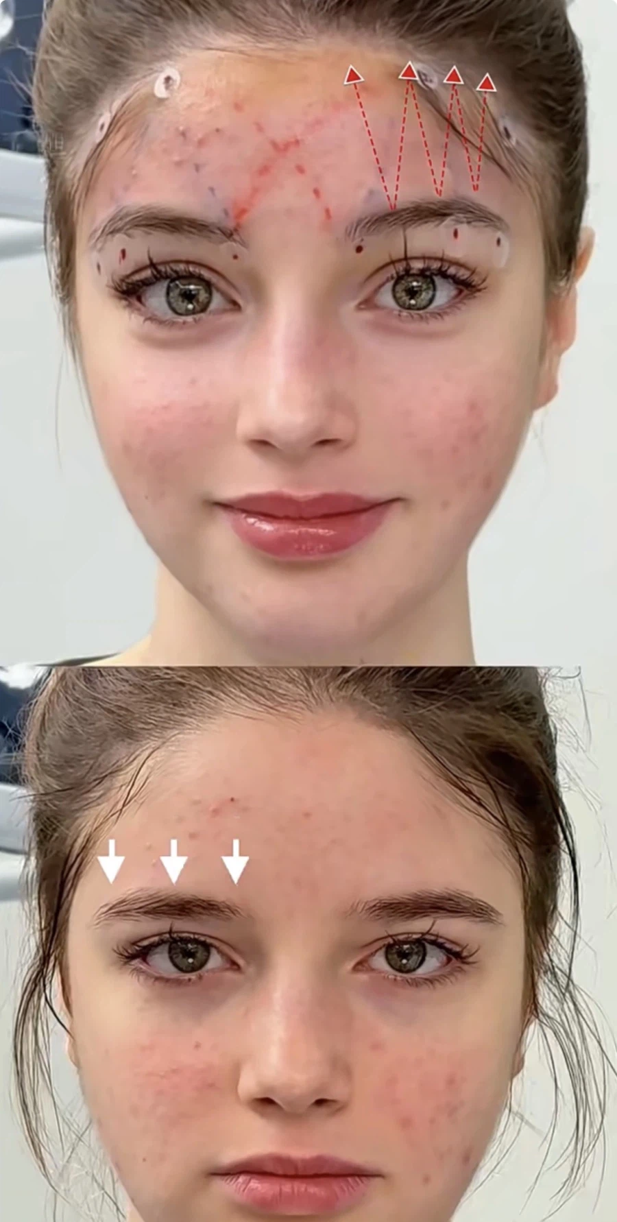 눈과 눈썹 간격을 벌려주는 수술 원리.jpg_5.webp