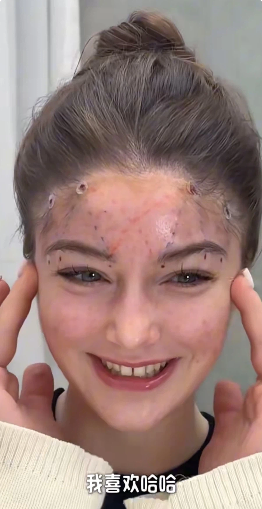 눈과 눈썹 간격을 벌려주는 수술 원리.jpg_6.webp