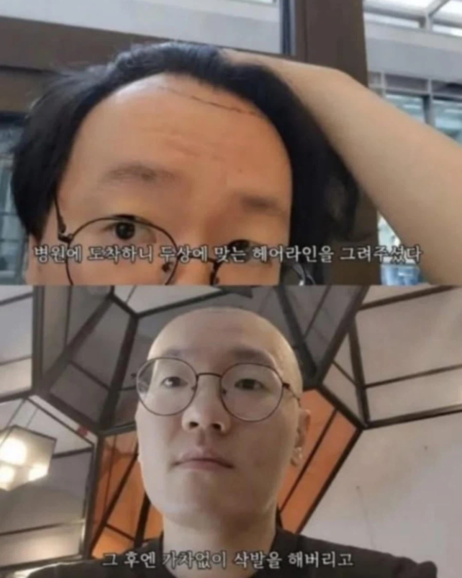 터키에 모발이식하러 갔더니 일어난 일 ㄷㄷㄷ_2.webp