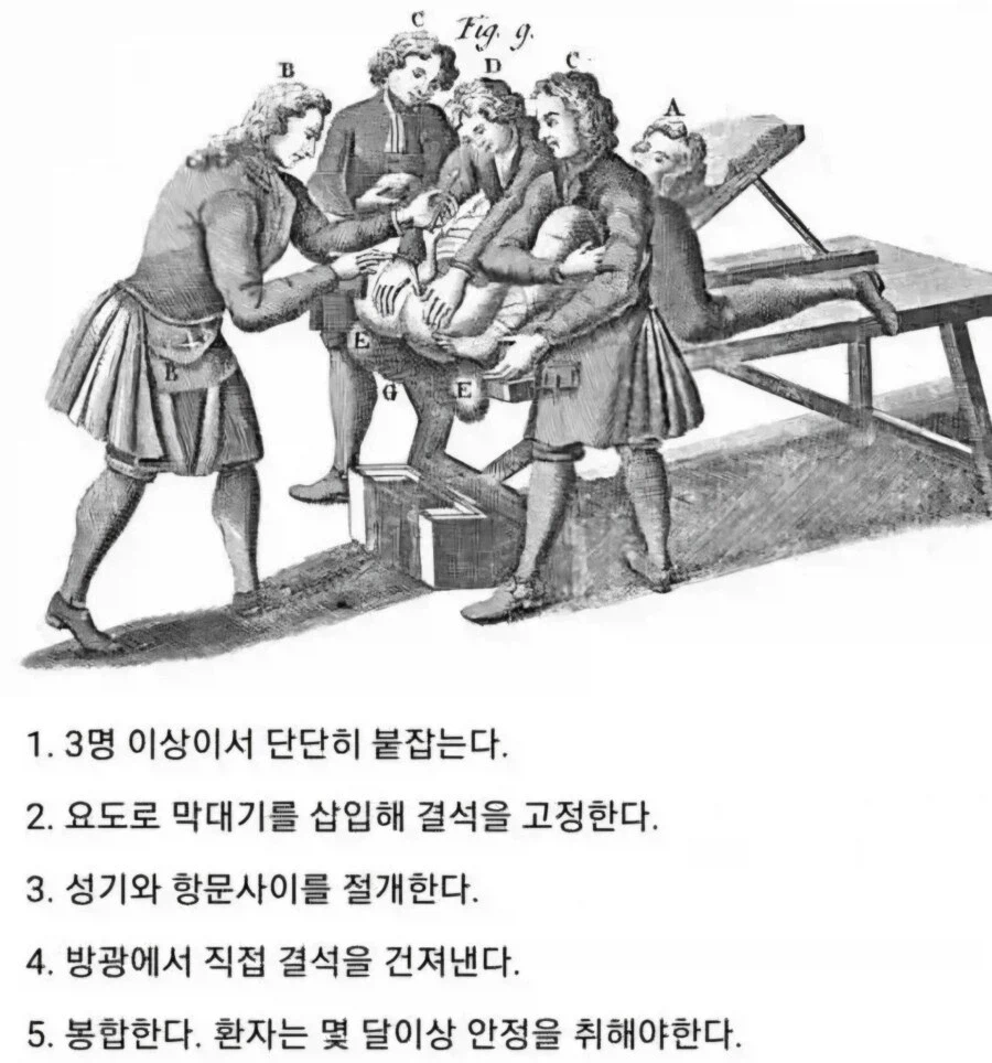 중세시대 요로결석 치료법.jpg_1.webp