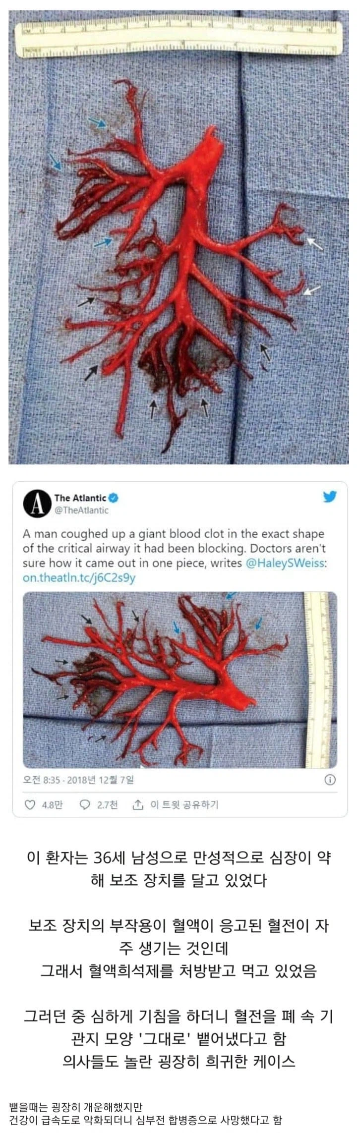 (혐) 기침을 했더니 혈전이 기관지 모양 그대로 나옴_1.webp