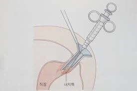 의외로 엉덩이에 넣으면 안 되는 것.jpg_4.webp