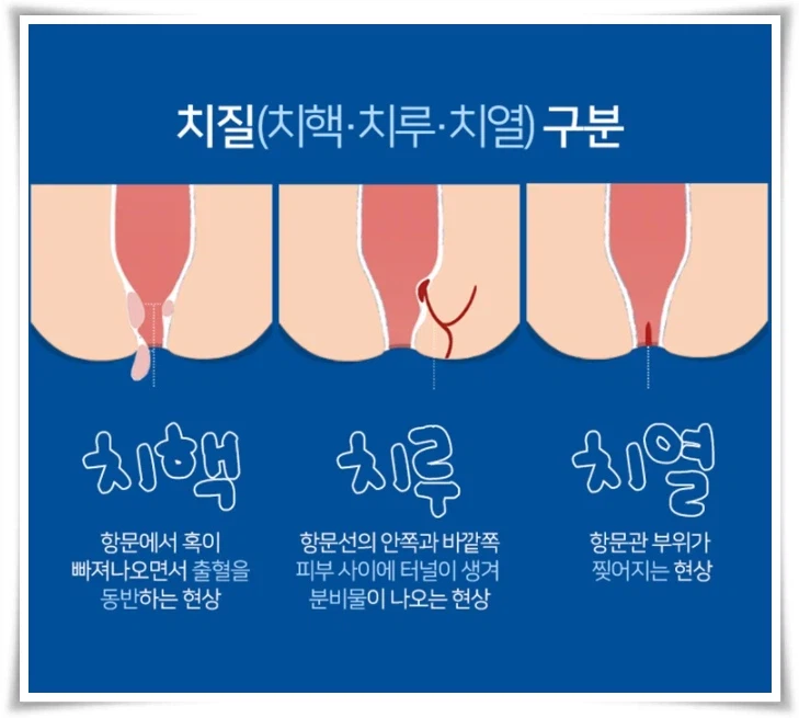 우리나라 사람들 10명중 3명은 하게된다는 수술_2.webp