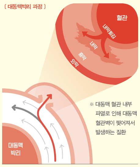 sp_5_대동맥박리과정.png