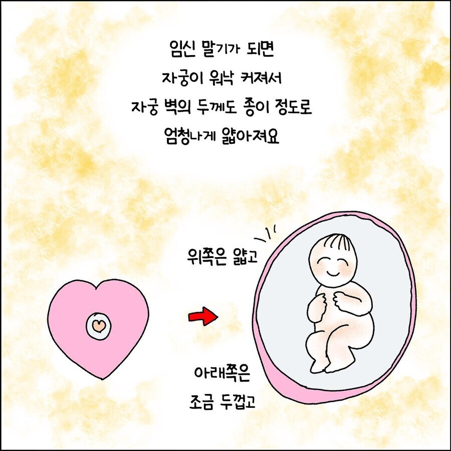 산부인과에서 출산 중 자궁파열 되는 만화_2.jpg