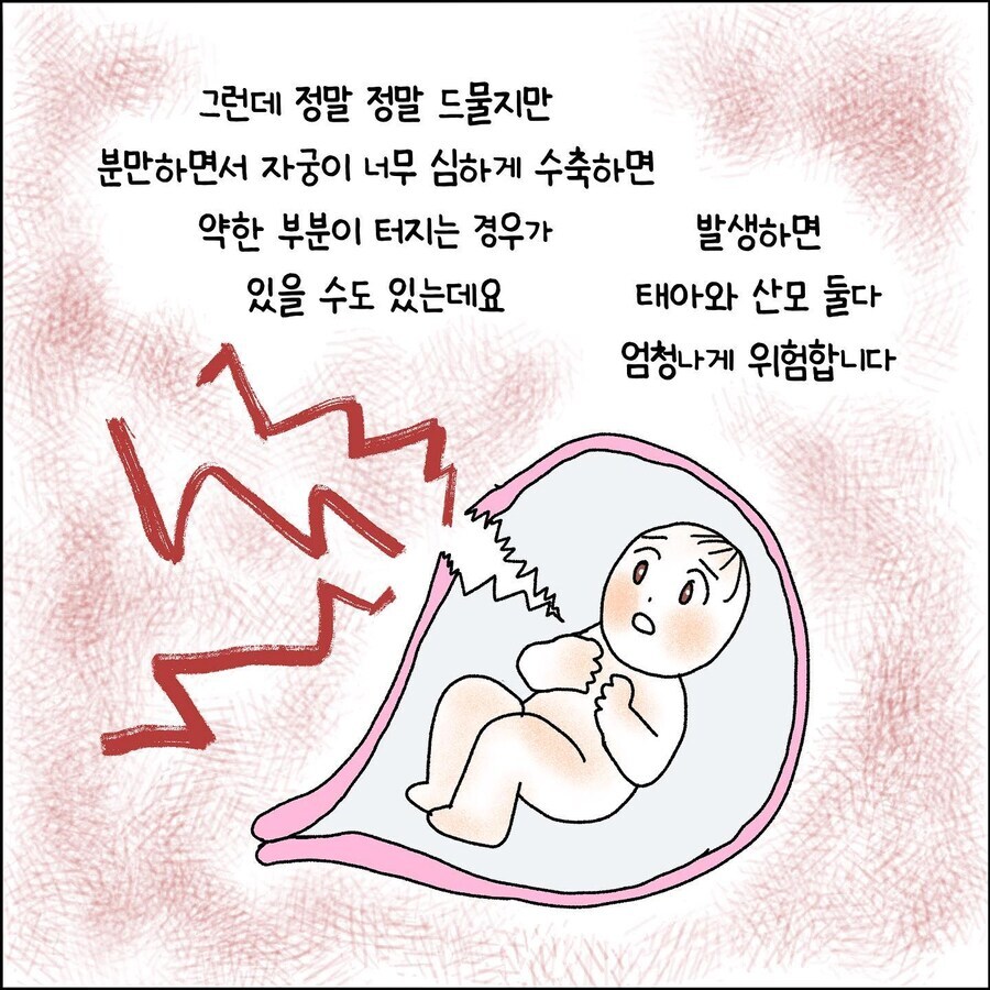 산부인과에서 출산 중 자궁파열 되는 만화_3.jpg