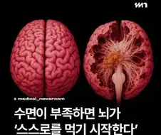 수면이 부족하면 뇌가 ＇스스로를 먹기 시작한다＇
